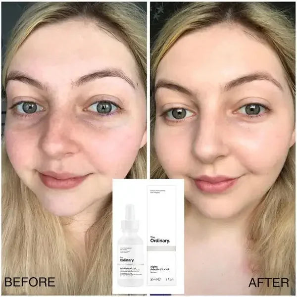 Before and after of woman using The Ordinary serum, smoother brighter skin results