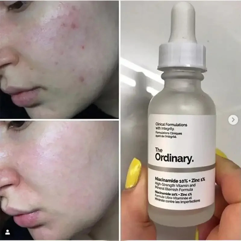 Before and after acne skincare results using The Ordinary Niacinamide 10% + Zinc 1% serum