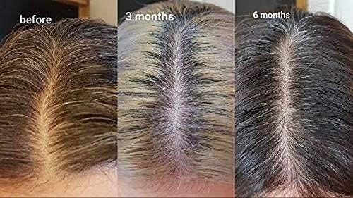 Scalp hair transformation over 6 months, from thinning to fuller, healthier regrowth