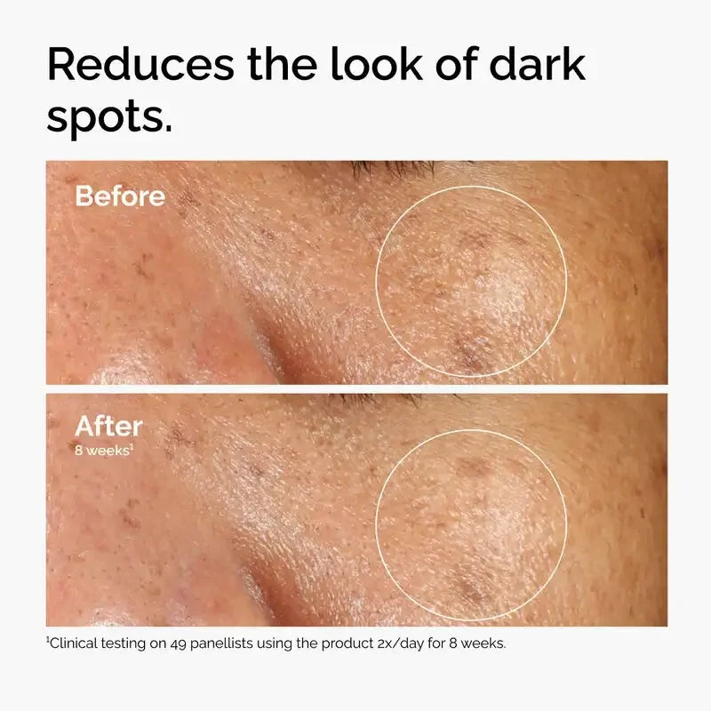 Before and after close-up of skin showing reduced dark spots after 8 weeks of skincare treatment.